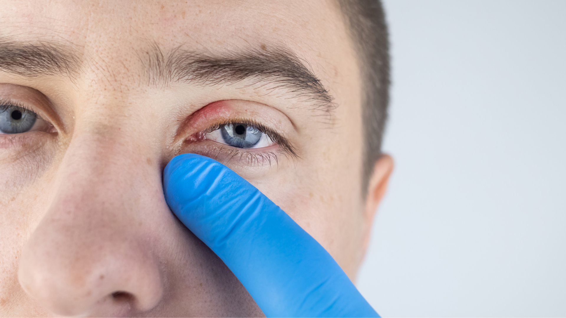 Blefarite | Dr. Rodolpho Felippe | Oftomologista